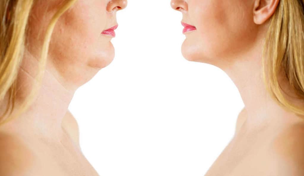 Double Chin treatment Barking and Dagenham before and after results