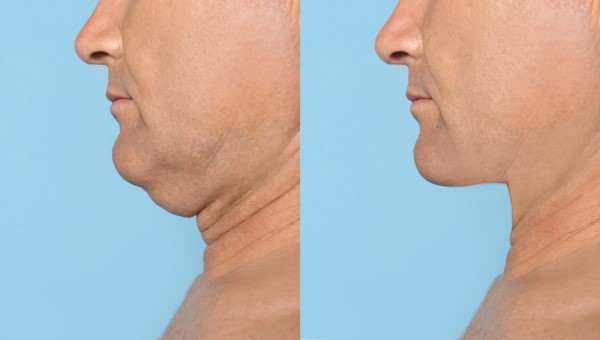Which Non-Surgical Treatments Work Best for Jowls and Loose Skin Barking and Dagenham?