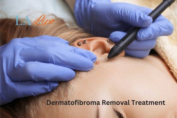 Dermatofibroma Removal Treatment Barking and Dagenham