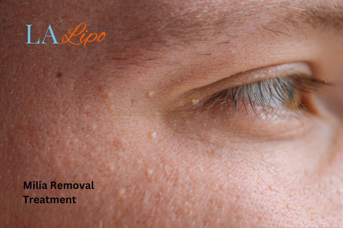 Cryopen Milia Removal: Is It the Easiest and Safest Option Barking and Dagenham?