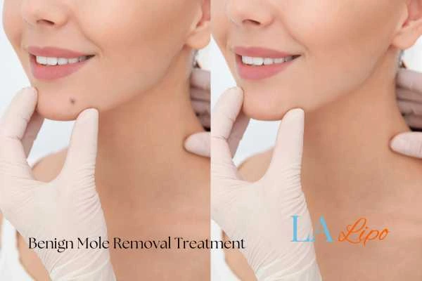 woman's before and after mole removal Barking and Dagenham results
