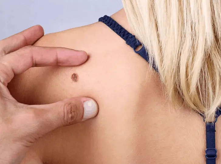 woman having mole removal Barking and Dagenham consultation before treatment.