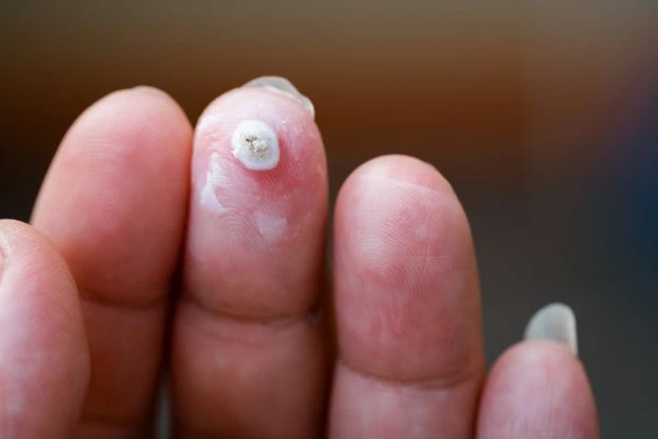 wart on person finger - cryotherapy to treat from LA LIPO Barking and Dagenham