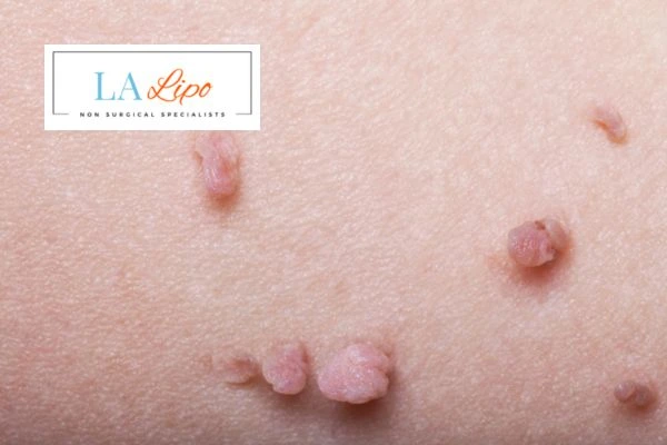 Does cryopen skin tag removal Barking and Dagenham hurt? Find out now call our team today!