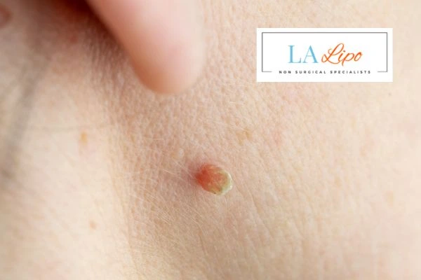 Book skin tag removal Barking and Dagenham today speak to our team now!