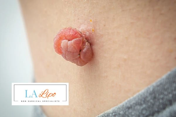 Interested in skin tag removal Barking and Dagenham? Concerned about the pain? Find out more today!