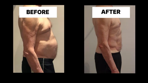 What Symptoms Can Diastasis Recti Cause in Men? Weak Core, Back Pain and Poor Posture Barking and Dagenham
